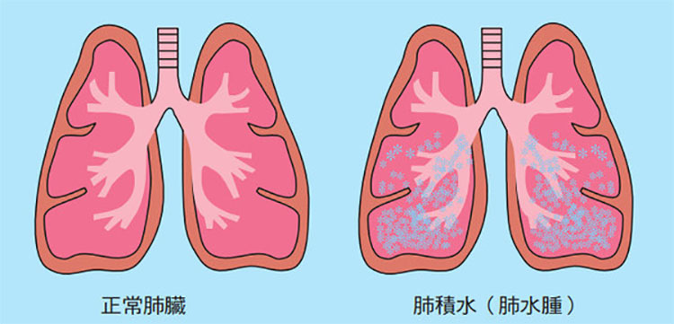 威而鋼在預防高山症中的應用